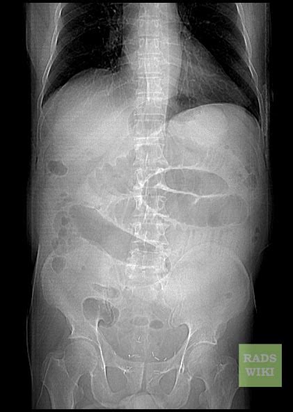 Spigelian hernia - wikidoc