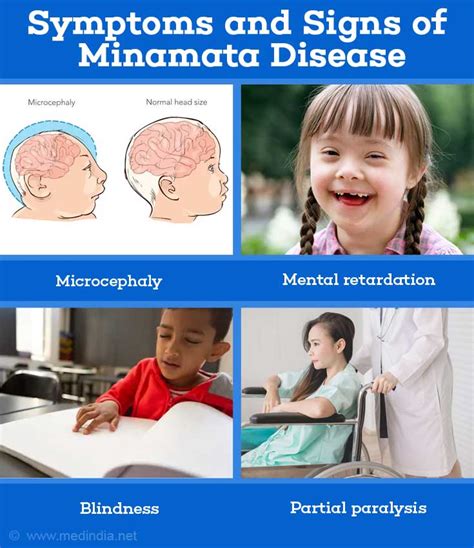 Minamata Disease - Causes, Symptoms, Signs, Diagnosis, Treatment