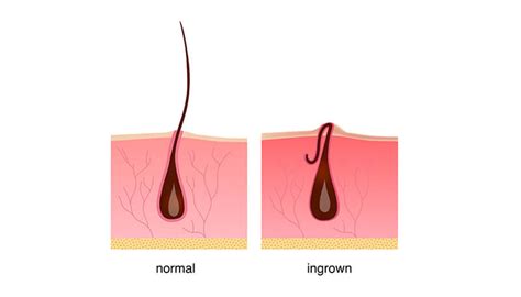 Using Laser Hair Removal to Eliminate Ingrown Hair - Vibrance MedSpa