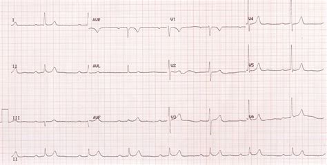 Sinus bradycardia with first degree AV block – All About Cardiovascular ...