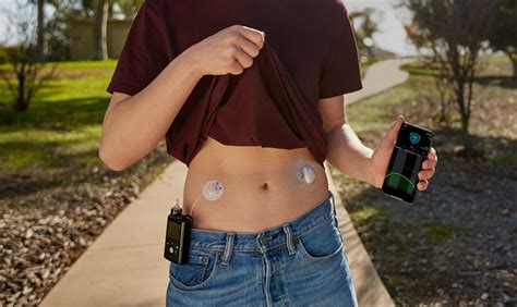 Medtronic rolls out Medtronic Extended insulin infusion set in US