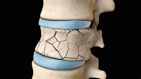 Why Kyphoplasty is the Best Option for Spinal Compression Fractures ...