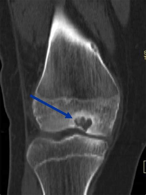 What are subchondral cysts: Hip Cysts | Subchondral Bone Cysts