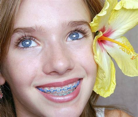 Purple Braces Color - Teeth Braces Ideas | Braces colors, Teeth braces, Cute braces colors