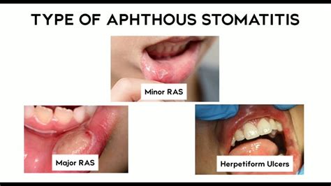 Recurrent Aphthous Stomatitis - YouTube