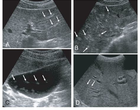 [PDF] Imaging diagnosis of clonorchiasis. | Semantic Scholar