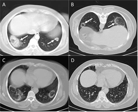 Pneumonia Chest Ct Scan - vrogue.co