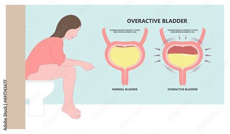 Vettoriale Stock urge pass urine of pelvic floor muscle frequently Bed wetting toilet urination ...