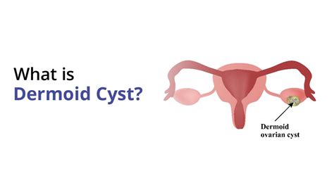 Dermoid Cyst Ovary Eye