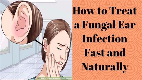 How to Treat a Fungal Ear Infection Fast and Naturally - YouTube | Ear infection remedy, Ear ...