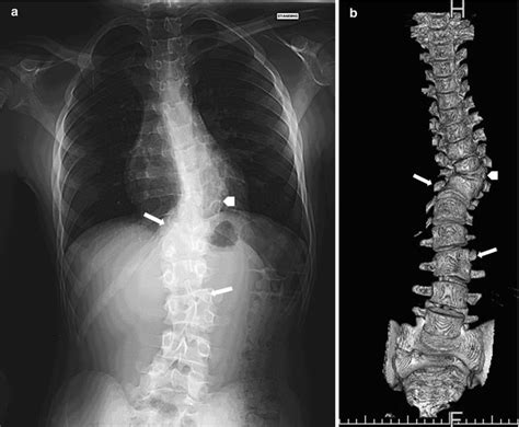 The Spine: Congenital and Developmental Conditions | Radiology Key