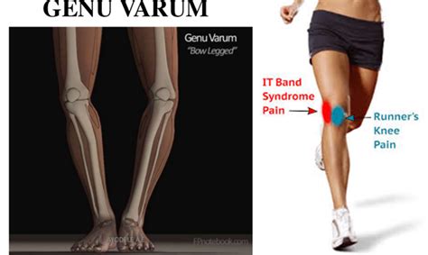 Diagnosing Lateral Thigh Pain: IT Band Syndrome, Hip Bursitis And Referred Back Pain Reid Clinic ...