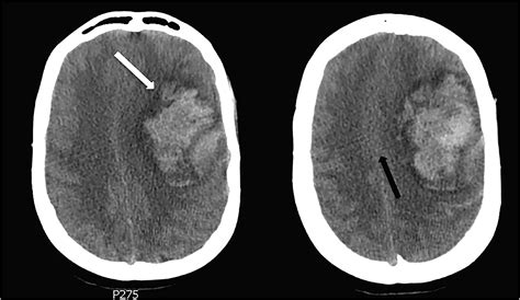 Severe Intracranial Hemorrhage at Initial Presentation of Acute Myelogenous Leukemia - The ...