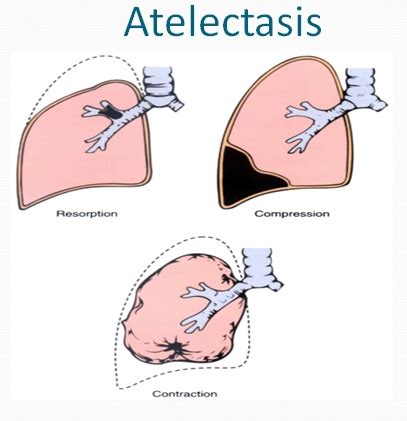 Atelectasis Causes, Symptoms, Diagnosis And Treatment - Natural Health News