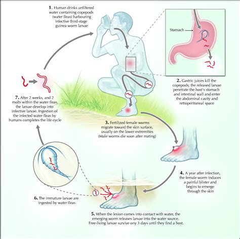 Dracunculiasis (guinea worm disease) | CMAJ