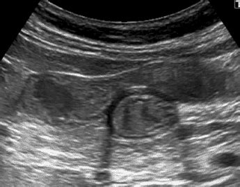 2. The hepatic artery carries oxygen | Imágenes de ultrasonido, Ultrasonido, Radiología