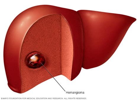 Liver hemangioma - Symptoms and causes - Mayo Clinic