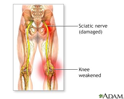 Sciatica Information | Mount Sinai - New York