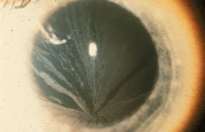 Vortex Keratopathy & Fabry Disease: A Case Series Highlighting the Role of the Optometrist ...