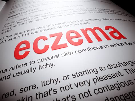 Harvard Health Ad Watch: A new injection treatment for eczema - Harvard ...