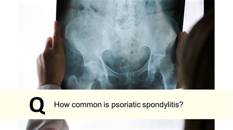 Psoriatic Arthritis Quiz: What are the five forms of PsA?