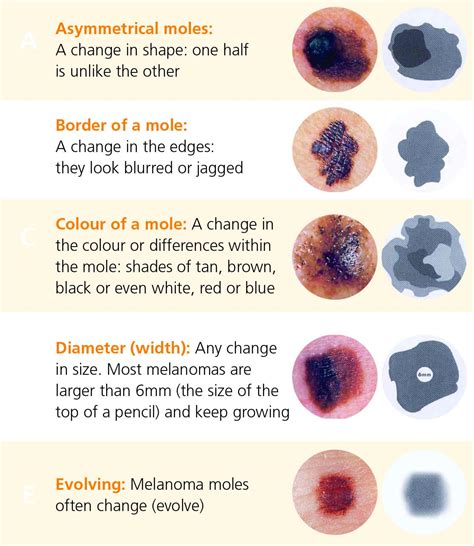 Signs Of Melanoma Skin Cancer