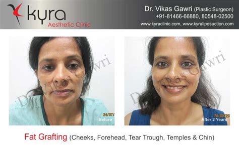 Before & After- Fat Transfer to Face - Cosmetic Surgery in Ludhiana ...