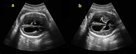 Severe Hydrocephalus In Fetus