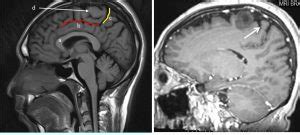 Central sulcus – Radiology Cases