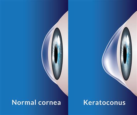 Keratoconus Treatment in Atlanta, GA - Woolfson Eye Institute