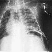 Full decompression of right pneumatocele has occurred following... | Download Scientific Diagram