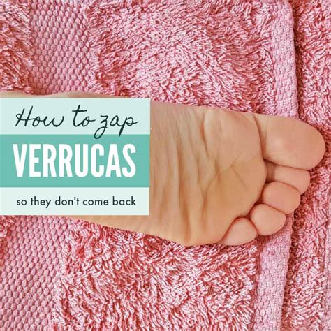 Get Rid of Verrucas Naturally