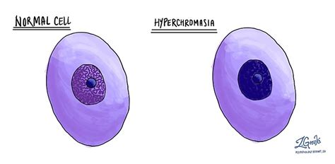 Hyperchromasia - MyPathologyReport.ca