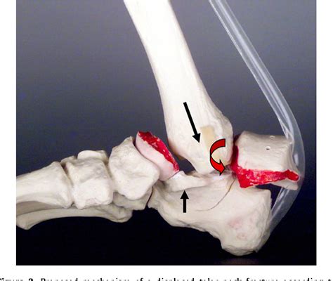 Figure 3 from Talar neck and body fractures. | Semantic Scholar