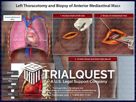 Left Thoracotomy and Biopsy of Anterior Mediastinal Mass - TrialExhibits Inc.