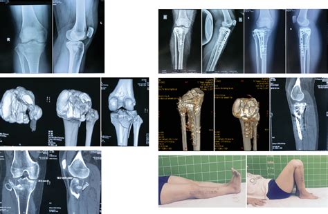 Surgical Treatment of Lateral Tibial Plateau Fractures Involving the Posterolateral Column ...