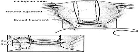 B-LYNCH SUTURE FOR POSTPARTUM HEMORRHAGE : Obstetrics & Gynecology