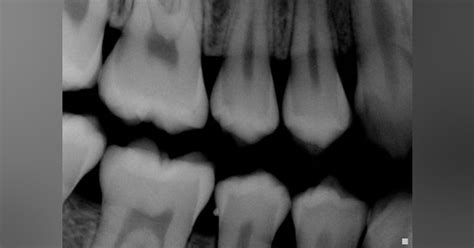 The elusive enamel pearl | Registered Dental Hygienists