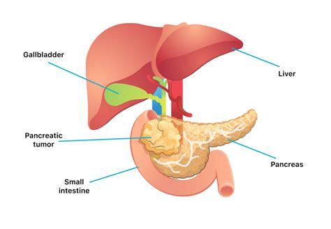 Pancreatic Cancer | Symptoms, Causes, Types, Stages and Treatment