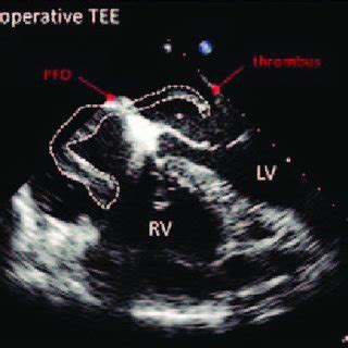 Uvula is deviated to the left side on admission | Download Scientific ...