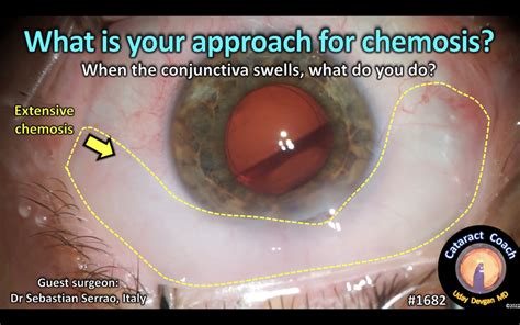 1682: what is your approach to chemosis? – Cataract Coach™