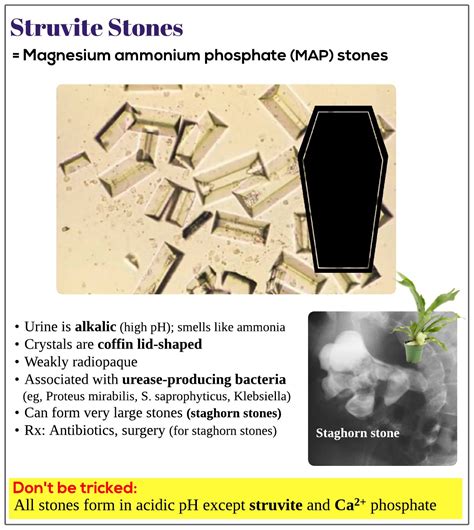 Struvite stones - Medicine Keys for MRCPs