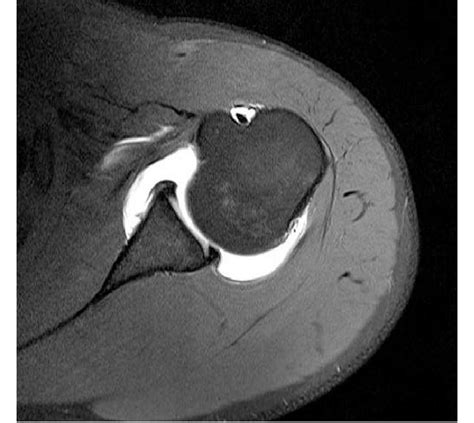 MRI showed normal position of biceps tendon in the bicipital groove. | Download Scientific Diagram