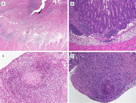 Lymphoid aggregates and granulomas. Representative images of H&E... | Download Scientific Diagram