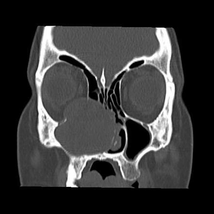 Maxillary sinus mucocele | Radiology Case | Radiopaedia.org