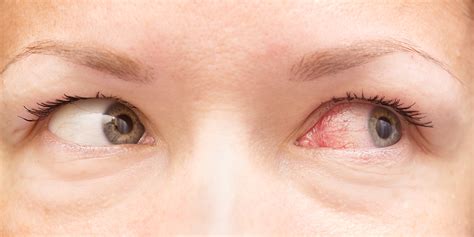 146 Images Viral Conjunctivitis For FREE - MyWeb