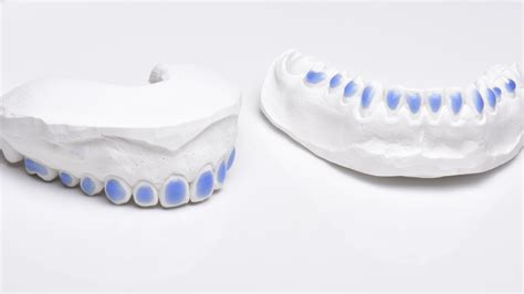 External Dental Bleaching - Styleitaliano.org