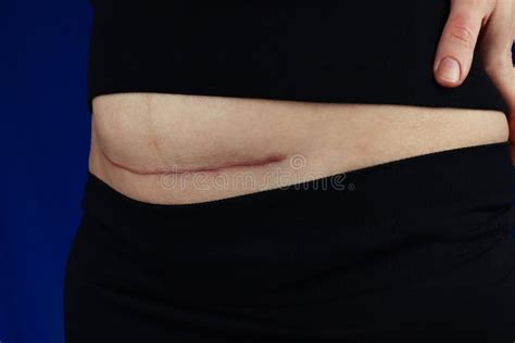 Cesarean Section Bandage. Postpartum Rehabilitation Stock Photo - Image ...