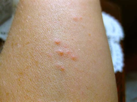 Kilohana K9s - Official Blog: What Do Bed Bug Bites Look Like?