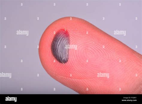 Blood blister on finger tip from crush injury Stock Photo - Alamy